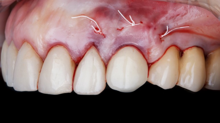 что делать после имплантации зубов что делать после имплантации зубов